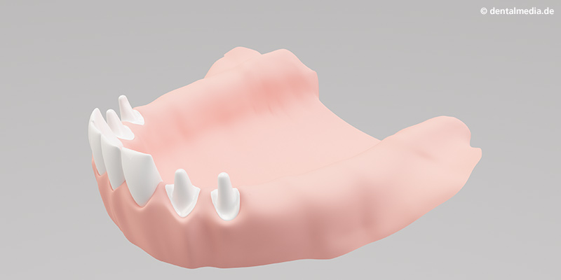 Ein Teil der bestehenden Zähne werden für den Kronenblock beschliffen