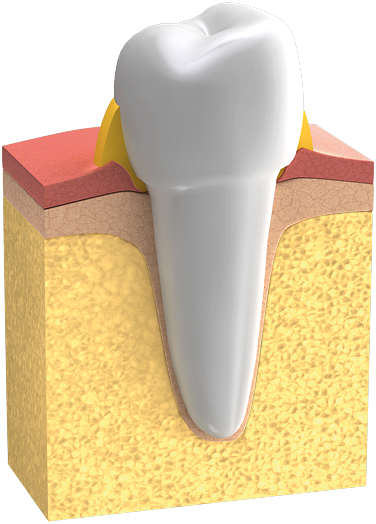 Erkranktes Zahnfleisch ist gerötet, blutet leicht und ist am Zahnhals häufig leicht geschwollen